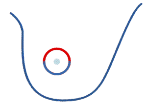 periareolar incision